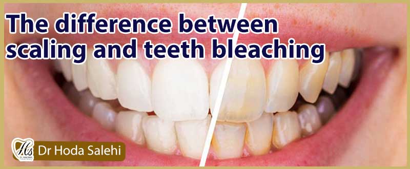 تفاوت بین جرمگیری و بلیچینگ دندان چیست؟