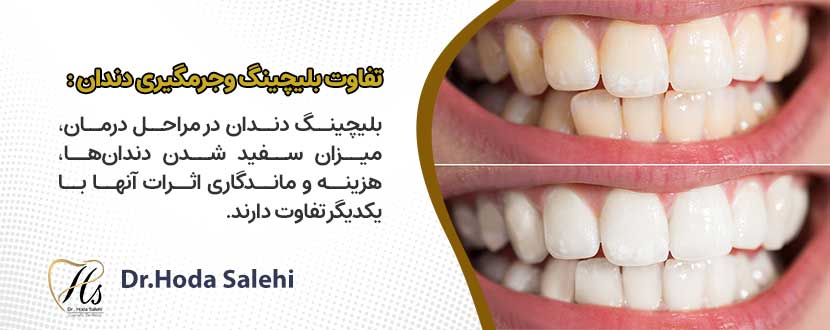 تفاوت بلیچینگ دندان و جرمگیری