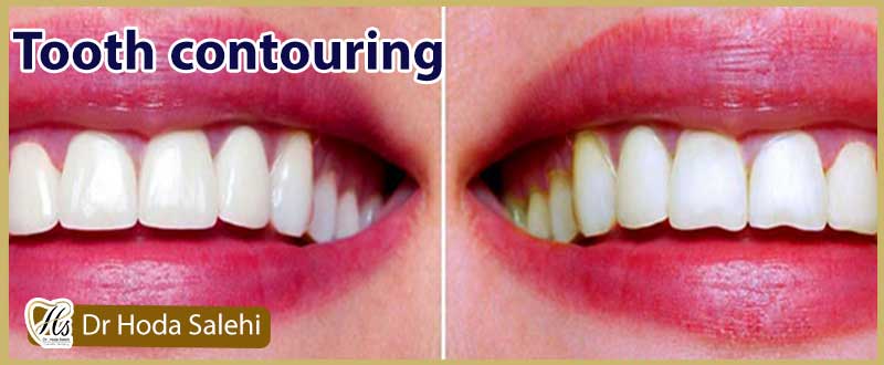 فرم دهی و تغیر شکل دندان با کانتورینگ دندان