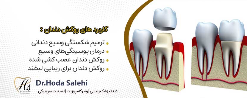کاربرد های روکش دندان