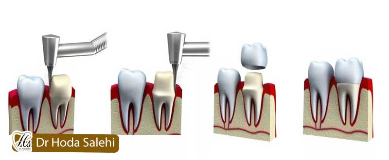 مراحل نصب روکش دندان