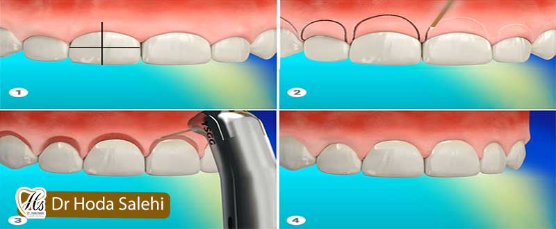 مراحل جراحی افزایش طول تاج دندان