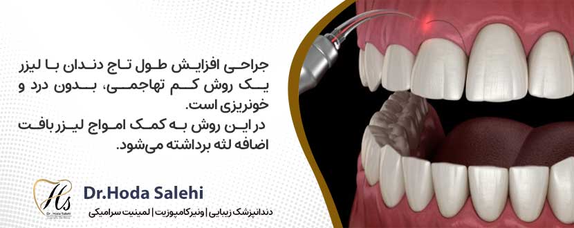 جراحی افزایش طول تاج دندان با لیزر