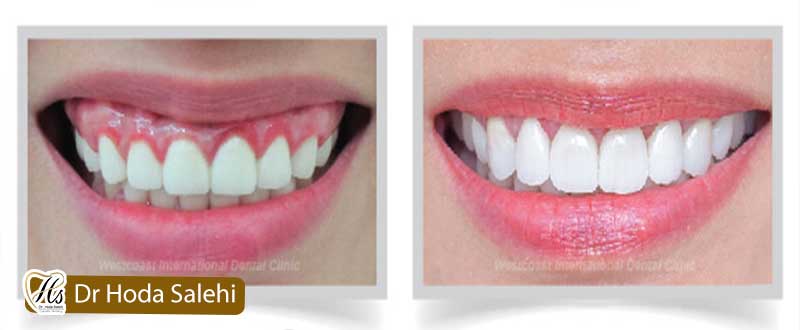 عکس افزایش طول تاج دندان