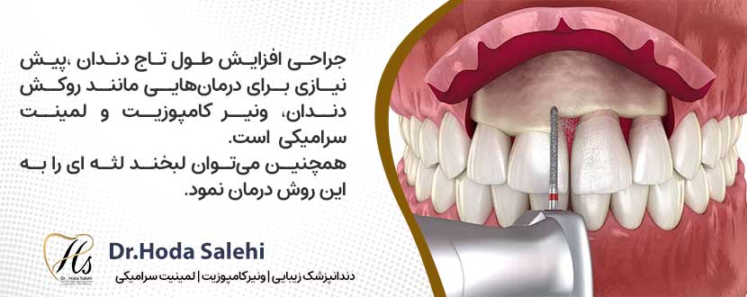 کاربرد های جراحی افزایش طول تاج دندان