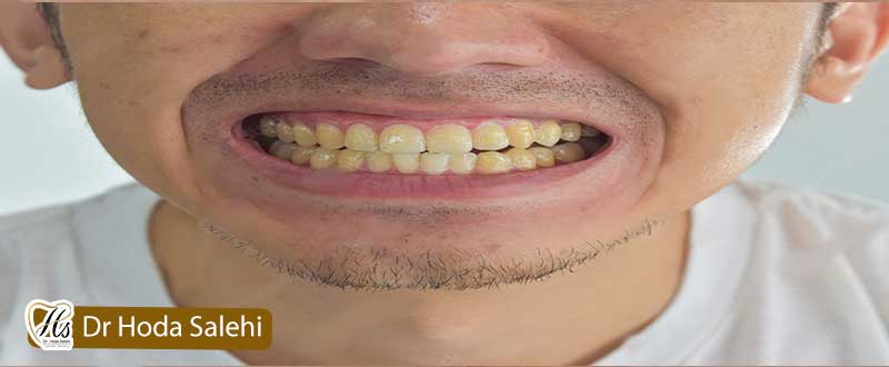 زرد شدن دندان پس از جرمگیری