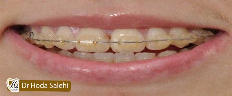 زرد شدن دندان ها پس از ارتودنسی