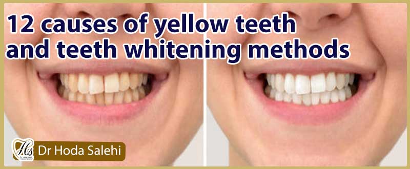 12 علت زرد شدن دندان و روشها سفید کردن دندان