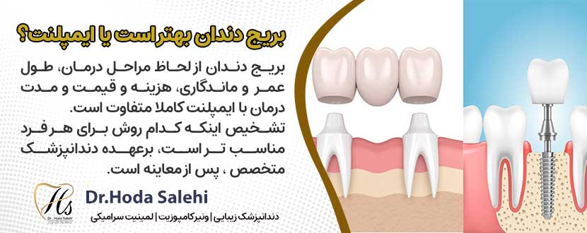 برای پر کردن جای خالی دندان ، ایمپلنت بهتر است یا بریچ دندانی ؟