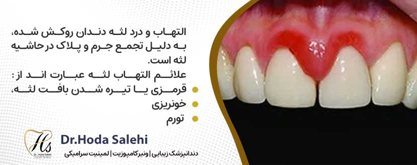 التهاب لثه بعد از روکش دندان
