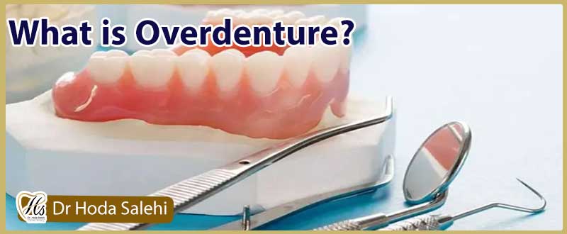 اوردنچر دندان چیست؟