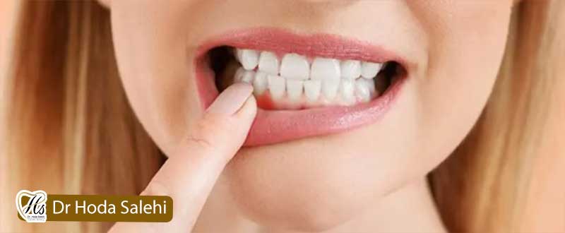 التهاب لثه پس از لمینت دندان
