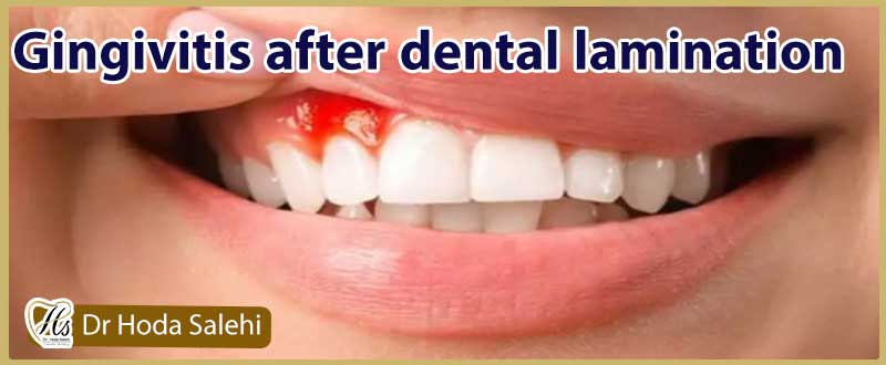 التهاب و عفونت لثه پس از لمینت دندان