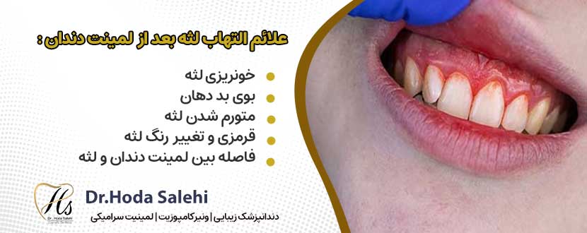 علائم التهاب لثه پس از لمینت دندان