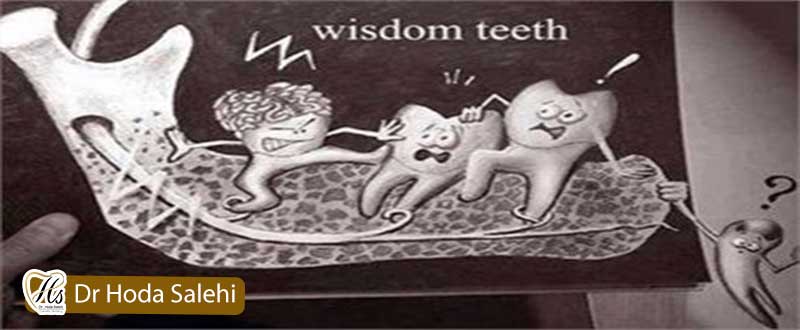 ایا رشد دندان عقل باعث کج شدن دندان ها میشود؟