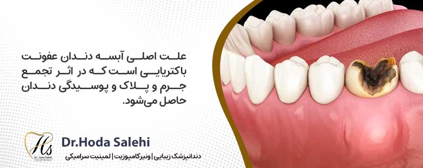 علت ابسه دندان